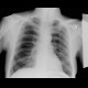 Fenestration of rib: X-ray - Plain radiograph